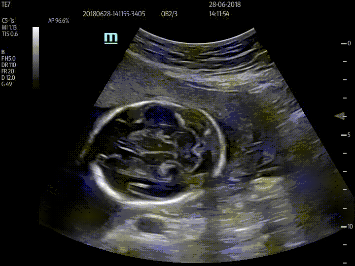 C5-1s_OB_Cerebellar plane_B_1